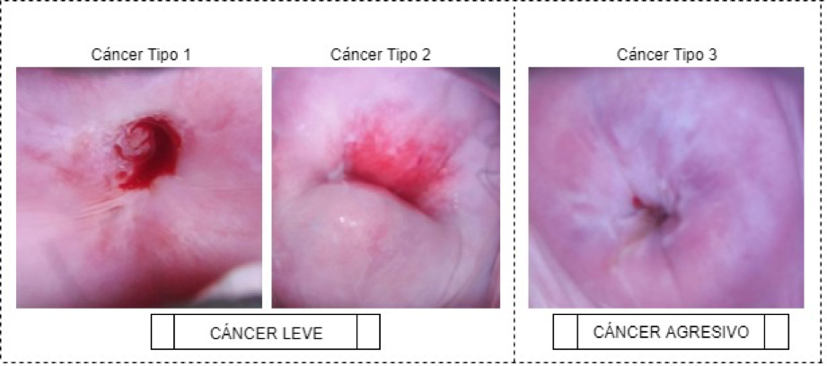 Imágenes de la cérvix del cáncer leve(Tipo 1 y Tipo 2) y cáncer agresivo(Tipo 3).