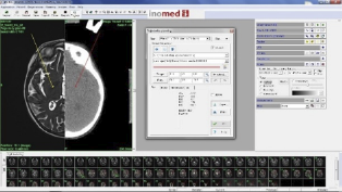 Tomografía cerebral con medio de contraste con resonancia magnética de cerebro secuencia T2 cortes axiales.